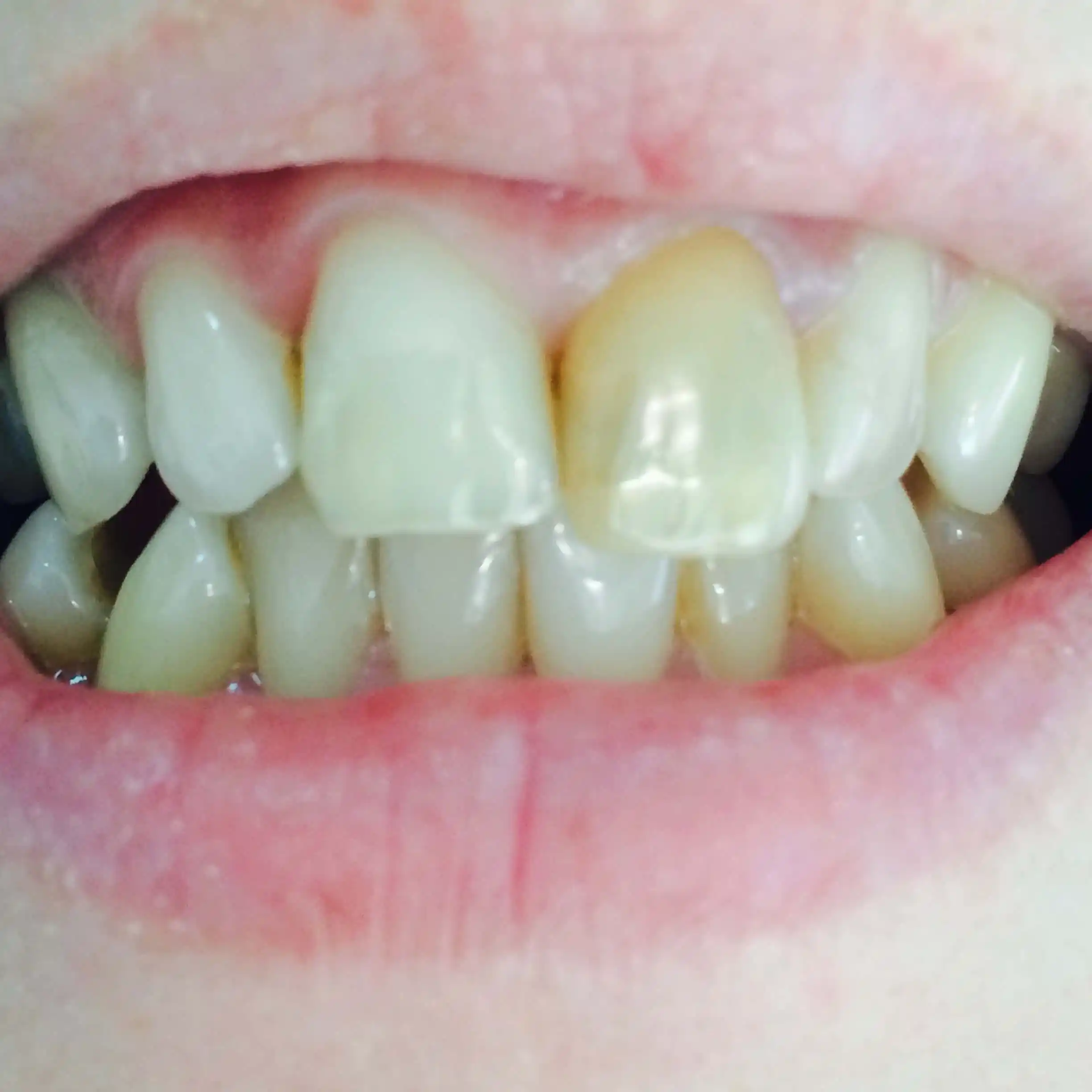Before: Emax ceramic crowns